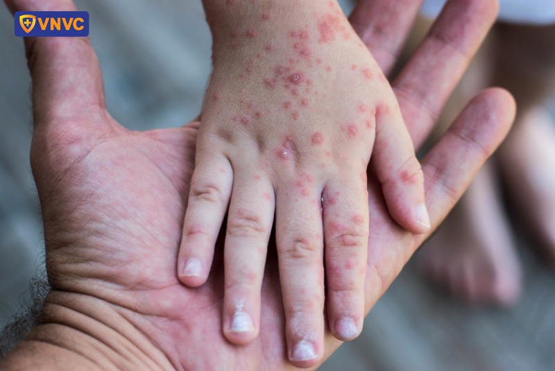 tay chân miệng ở trẻ sơ sinh
