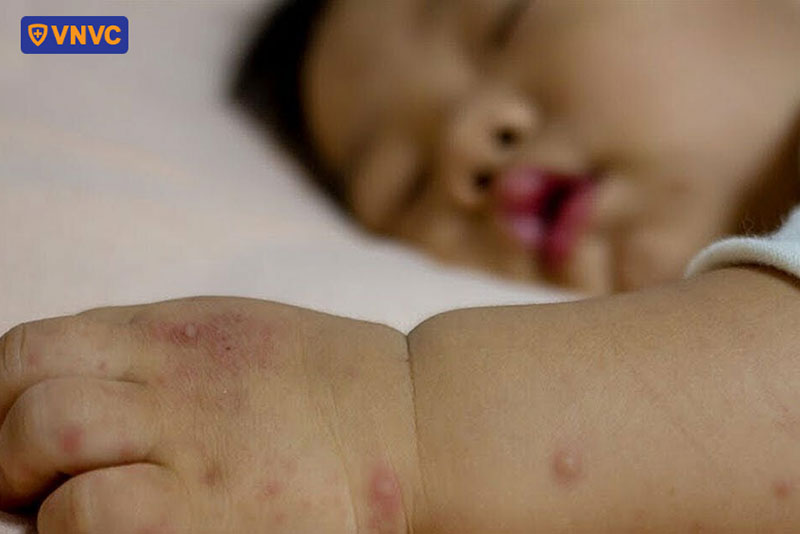 tay trẻ nổi mẫn đỏ