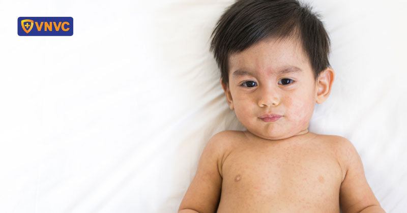 trẻ em bị bệnh sởi