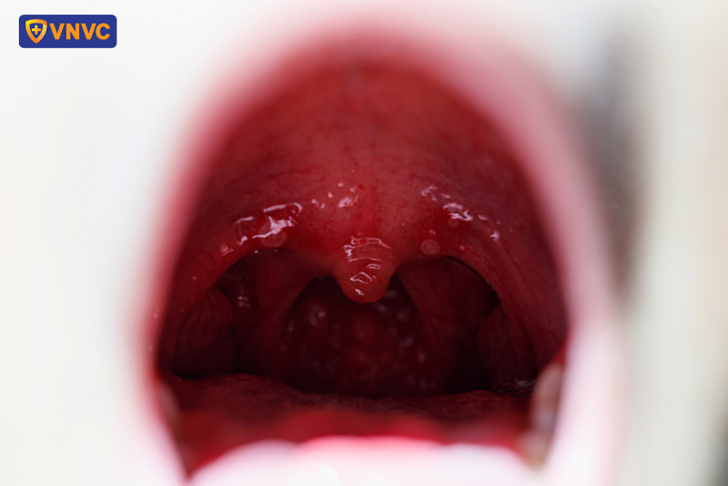 trẻ sơ sinh loét miệng do tay chân miệng