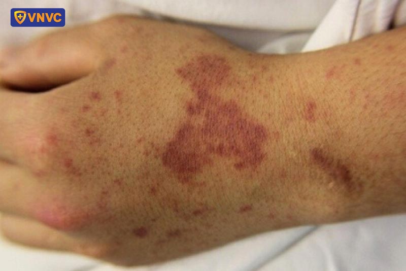 triệu chứng của não mô cầu