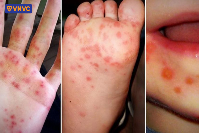 bé bị tay chân miệng bội nhiễm