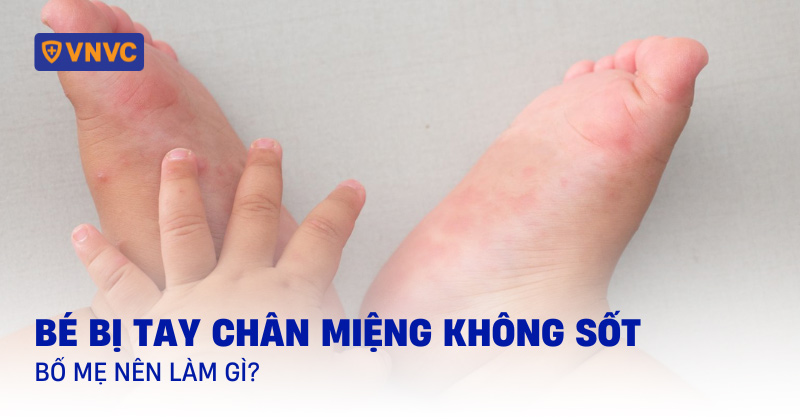 bé bị tay chân miệng không sốt