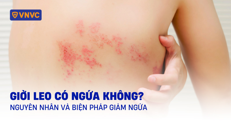 bị giời leo có ngứa không