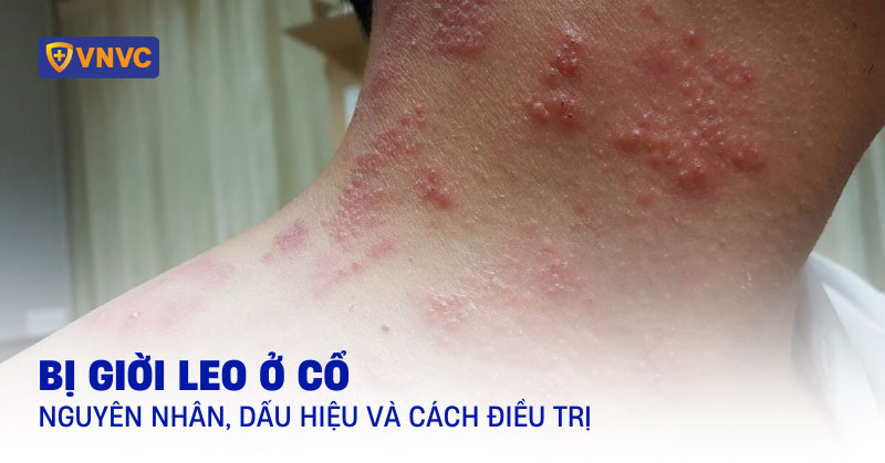 bị giời leo ở cổ