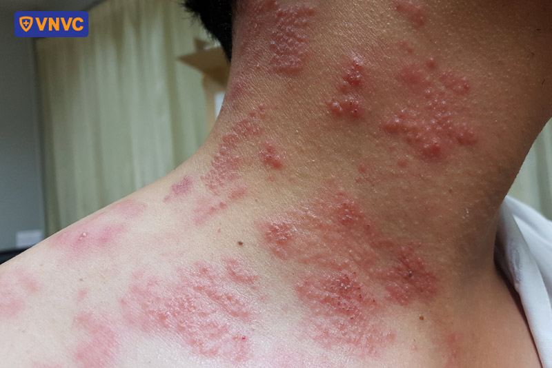 bị nổi zona ở cổ