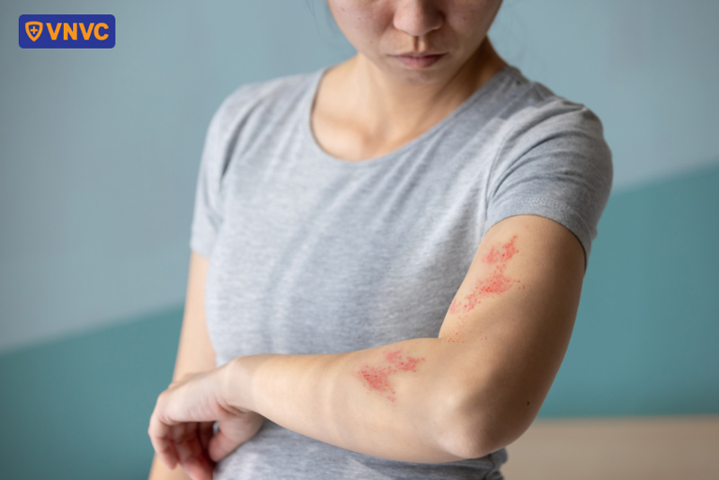 bị zona có kiêng ăn thịt bò