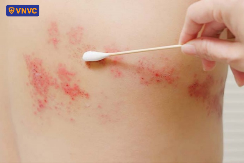 bị zona có nên bôi nha đam