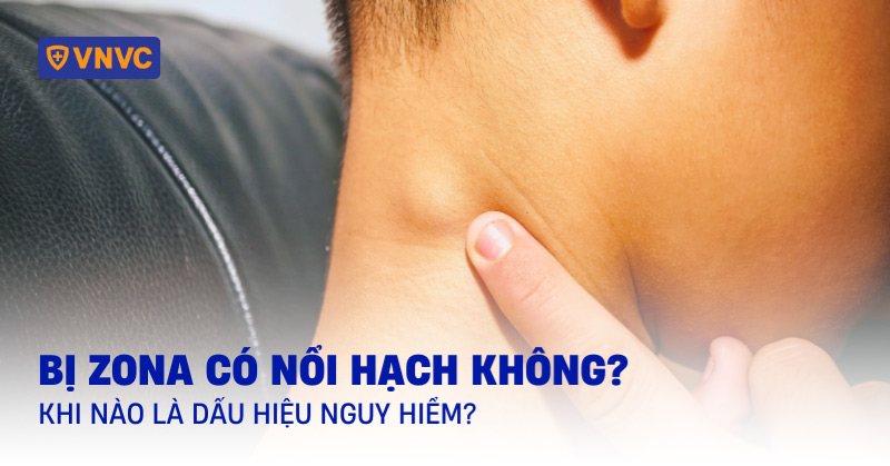 Bị zona có nổi hạch không? Khi nào là dấu hiệu nguy hiểm?