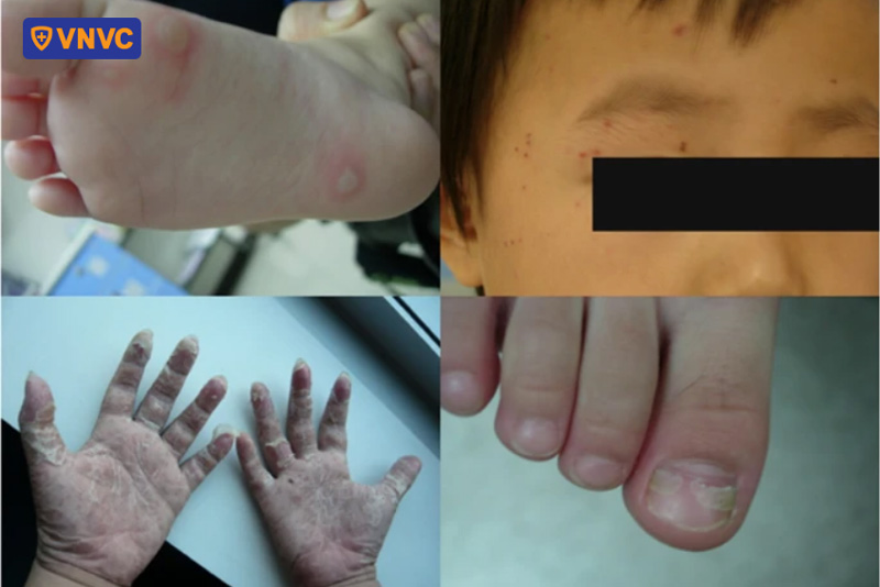biểu hiện tay chân miệng không điển hình