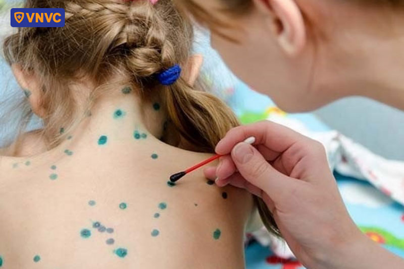 bố mẹ nên hạn chế cho trẻ tiếp xúc với những người mắc bệnh thủy đậu hoặc zona