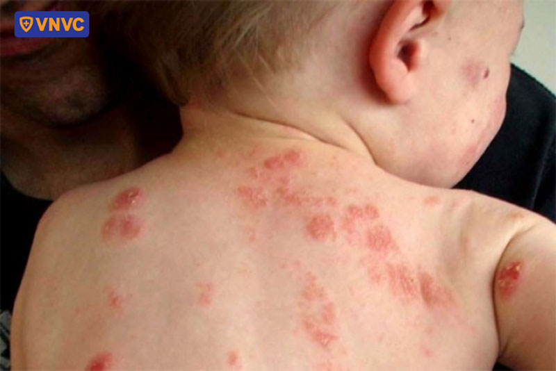 các nốt ban đỏ phát triển thành mụn nước
