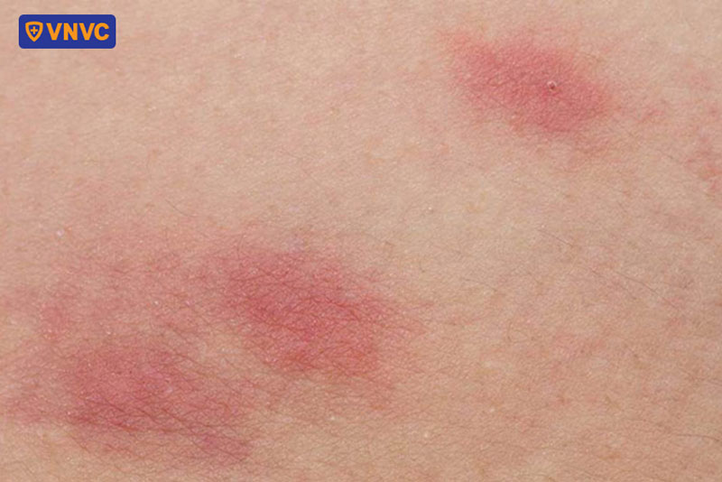 các nốt ban đỏ