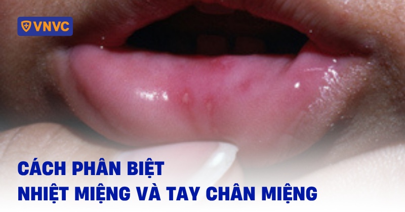 cách phân biệt nhiệt miệng và tay chân miệng ở trẻ