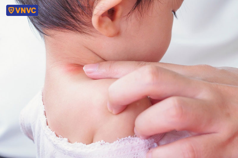 chăm sóc trẻ bị zona thần kinh đúng cách