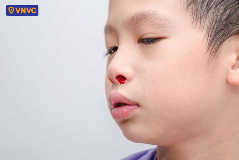 chảy máu mũi cũng là triệu chứng sốt xuất huyết đặc trưng