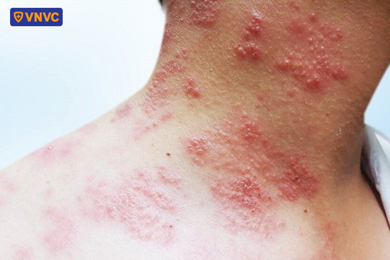 da vùng cổ nổi mẩn đỏ