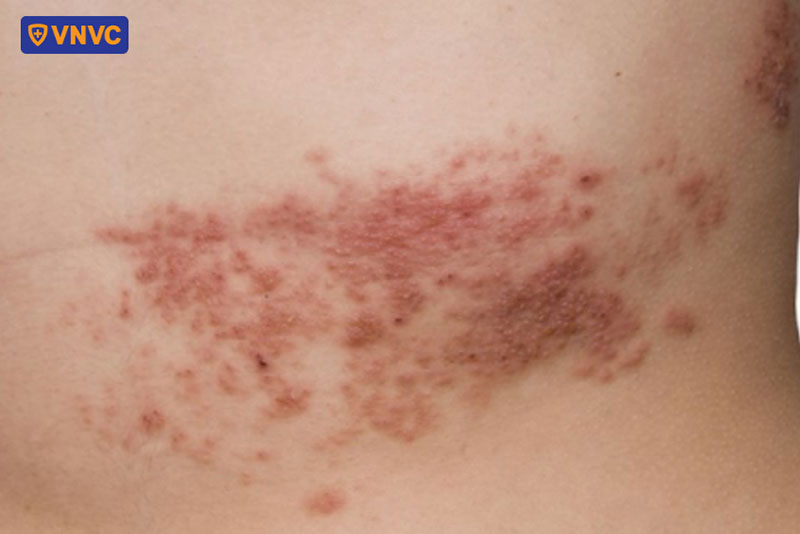 da vùng cổ xuất hiện những vết loét