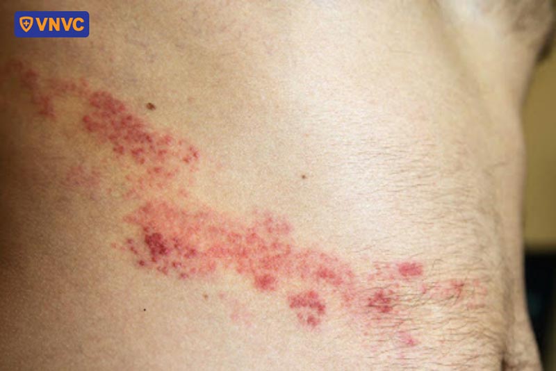 dấu hiệu của bệnh zona thần kinh