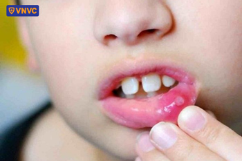 dấu hiệu nhận biết nhiệt miệng