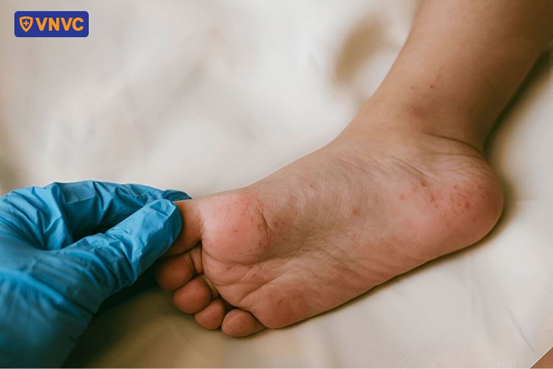 dấu hiệu phát ban ở lòng bàn chân