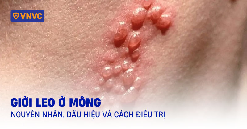 giời leo ở mông