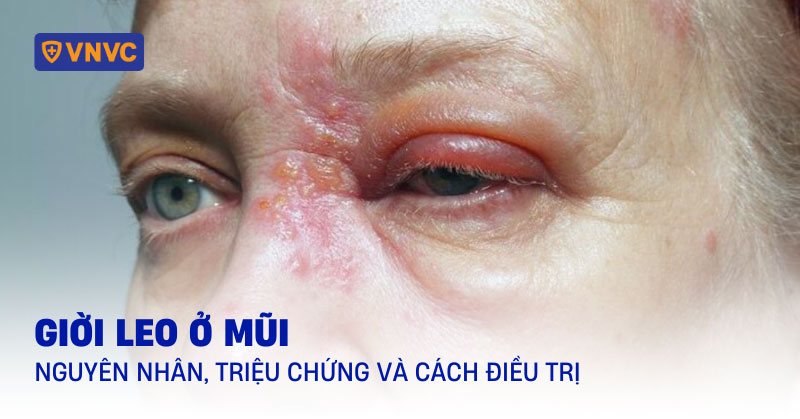 giời leo ở mũi