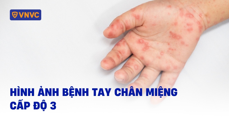 hình ảnh bệnh tay chân miệng cấp độ 3 ra sao