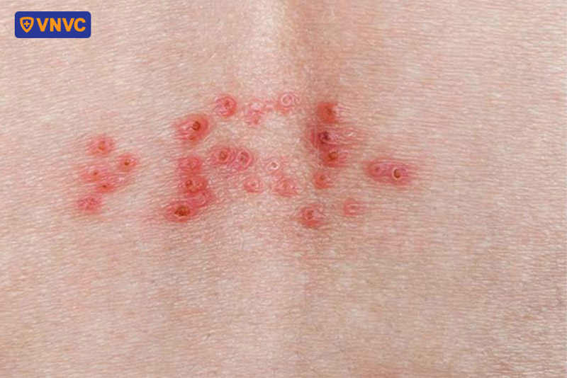 hình ảnh bệnh zona giai đoạn hồi phục