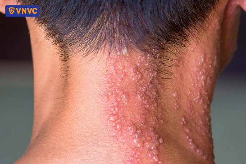 hình ảnh bệnh zona ở cổ