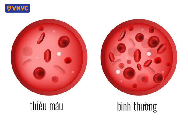 hình ảnh hồng cầu giảm trong sốt xuất huyết