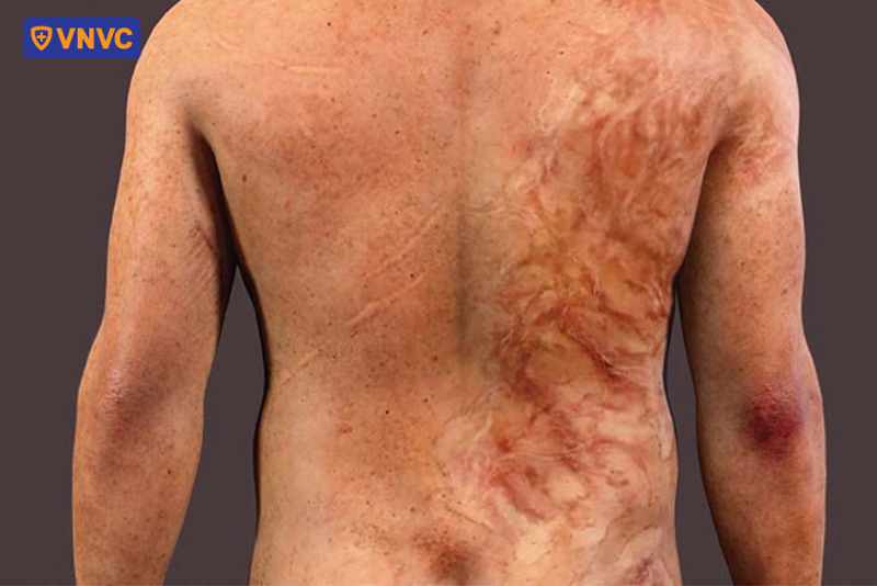 hình ảnh lưng bị ảnh hưởng bởi zona