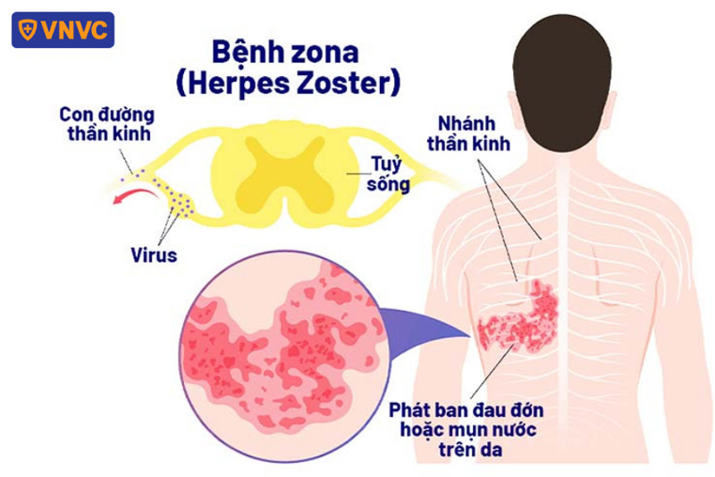 hình ảnh mô tả zona thần kinh ở lưng