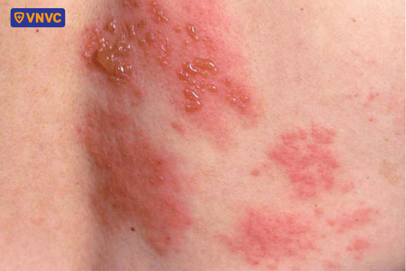hình ảnh mụn nước giời leo