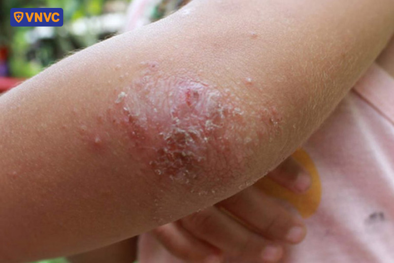 hình ảnh tay chân miệng giai đoạn hồi phục