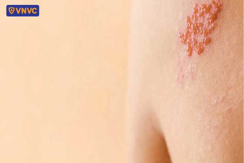 hình ảnh zona thần kinh giai đoạn bùng phát