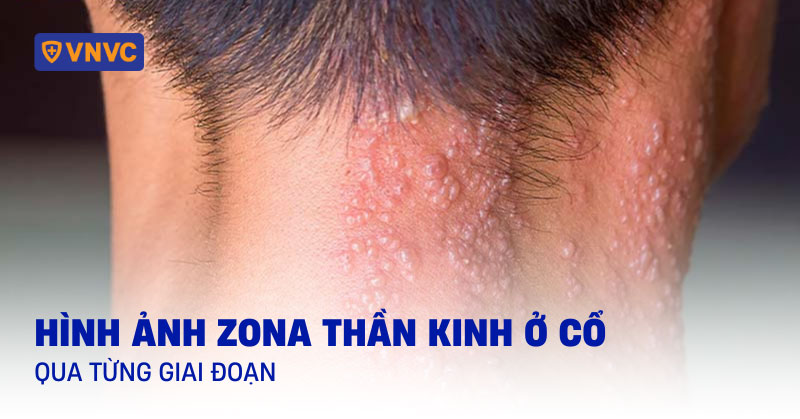 hình ảnh zona thần kinh ở cổ