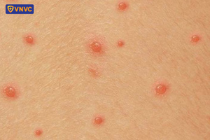 hình dạng mụn nước thủy đậu