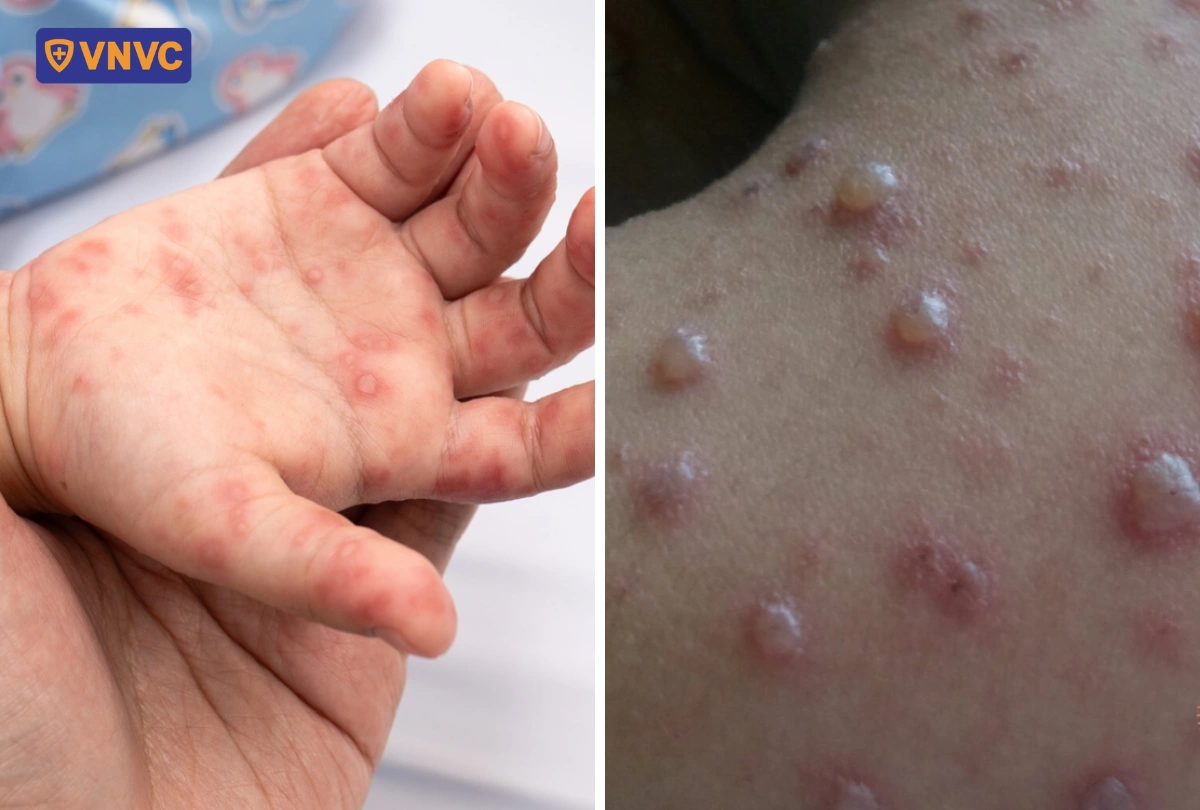 khác biệt giữa mụn thủy đậu và tay chân miệng