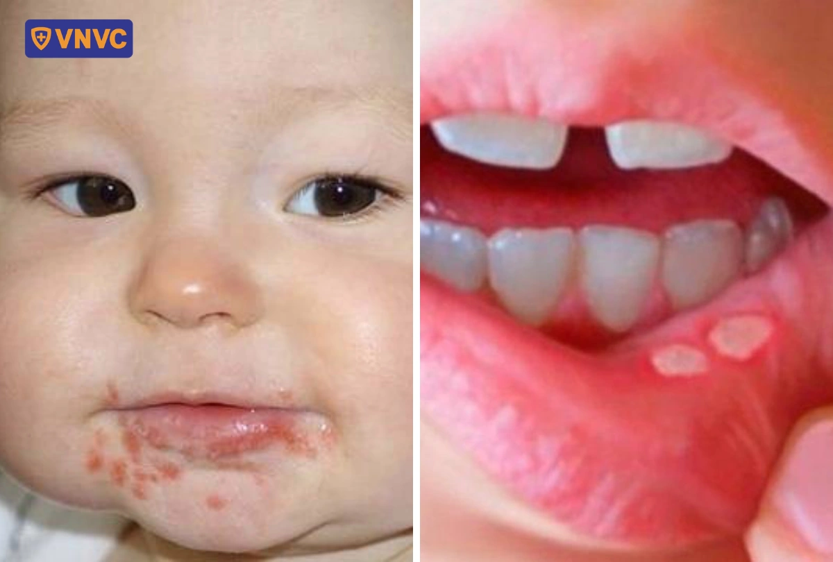 khác biệt loét miệng và tay chân miệng
