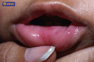 loét miệng do tay chân miệng