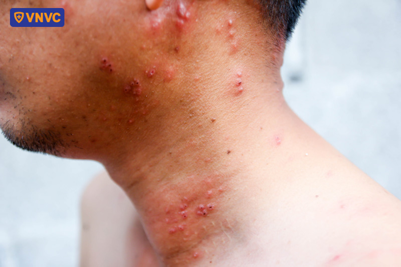 mắc bệnh zona có nổi hạch không