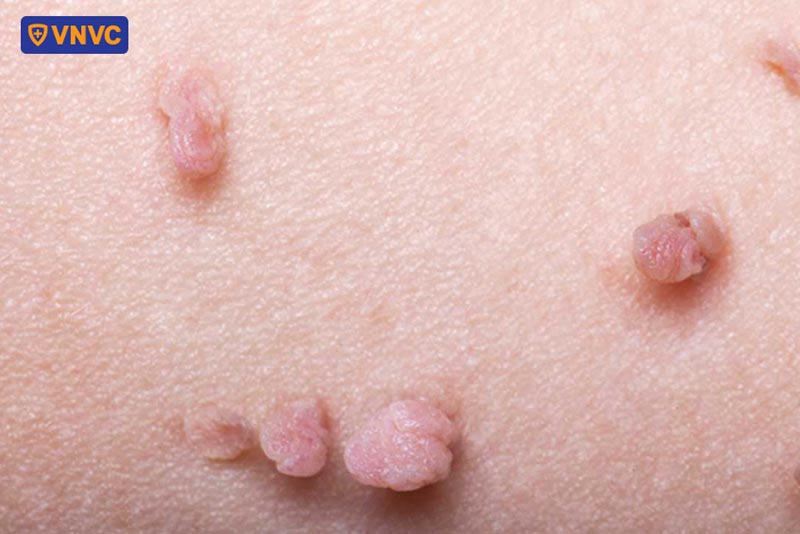 mụn có sinh dục do hpv 66
