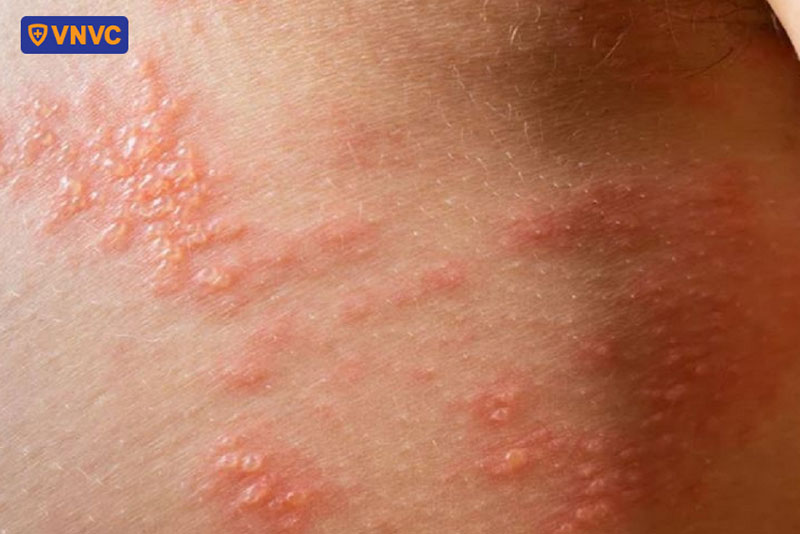 mụn nước giời leo lan rộng