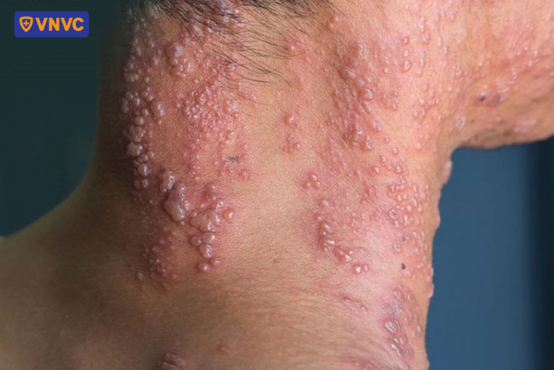 mụn nước nhỏ chứa dịch trong suốt