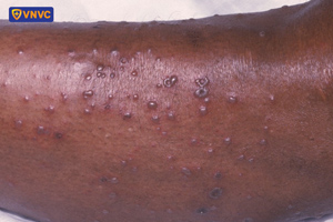 mụn nước ở bệnh thủy đậu