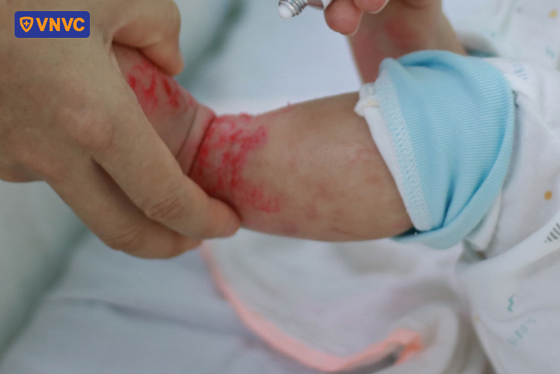 mụn nước tay chân miệng