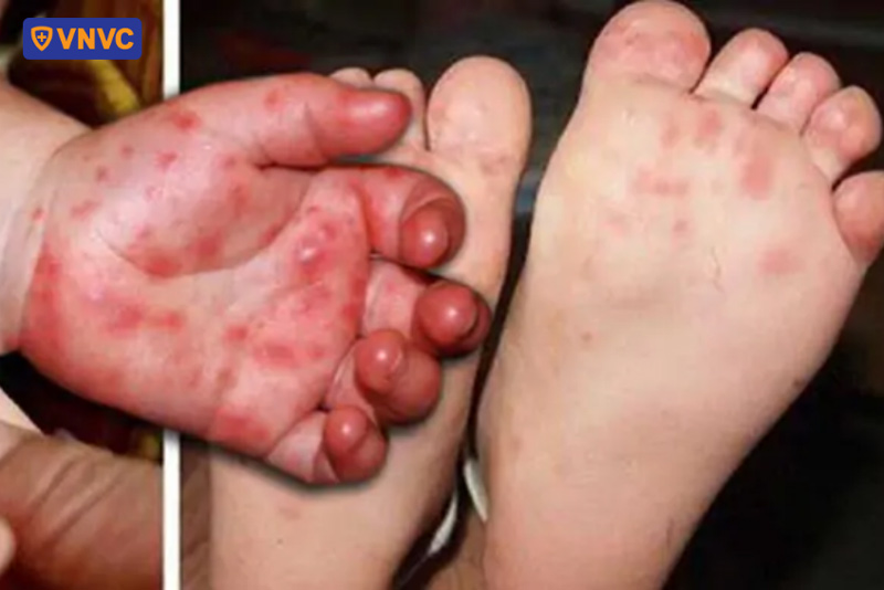 mụn nước tay chân miệng chứa dịch