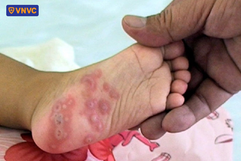mụn nước tay chân miệng ở chân
