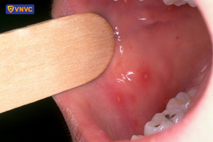 mụn nước tay chân miệng